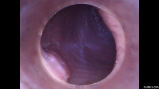 Silvie DeLuxe  RAW endoscopic video  2015-08-23l