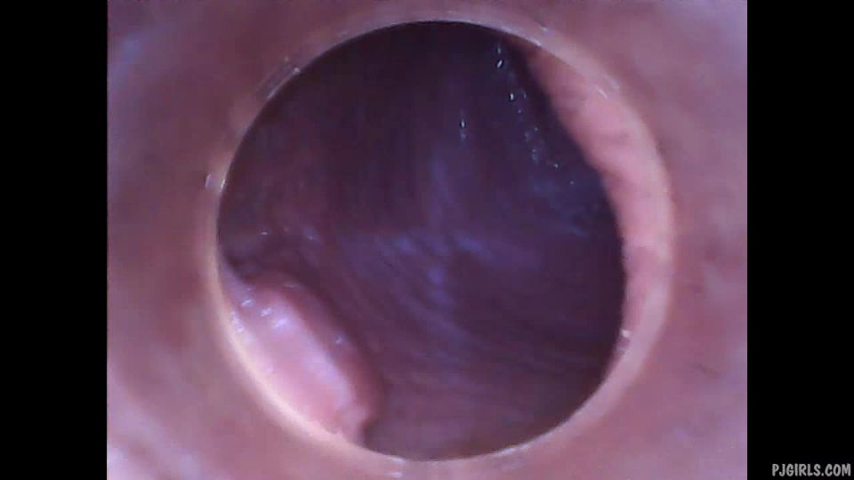 Silvie DeLuxe  RAW endoscopic video  2015-08-23l